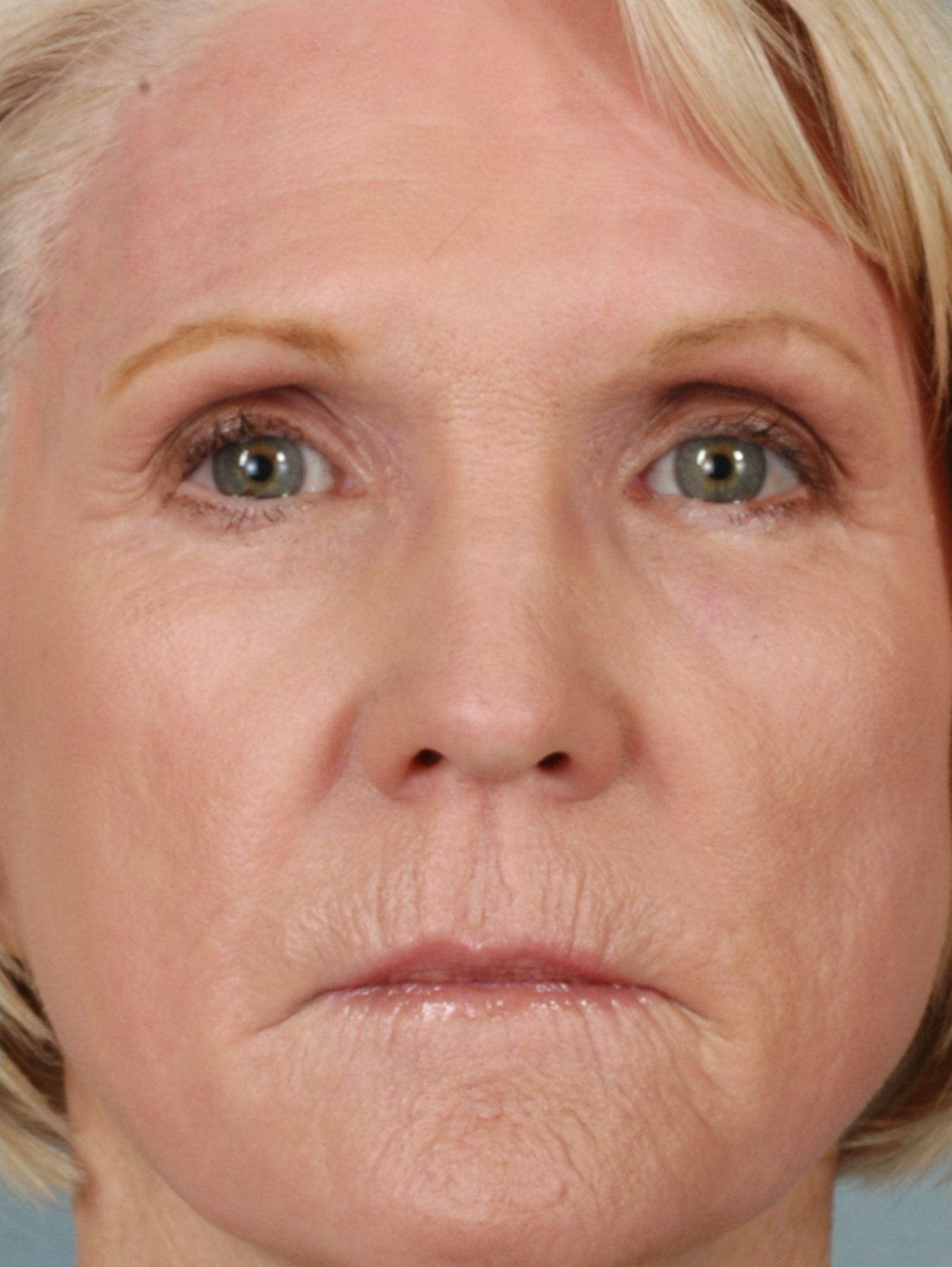Laser Resurfacing Patient Photo - Case 15893 - after view-1