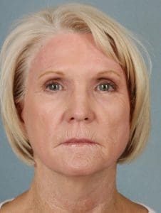 Laser Resurfacing - Case 15893 - After