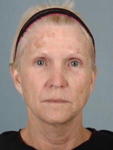 Laser Resurfacing - Case 15893 - Before