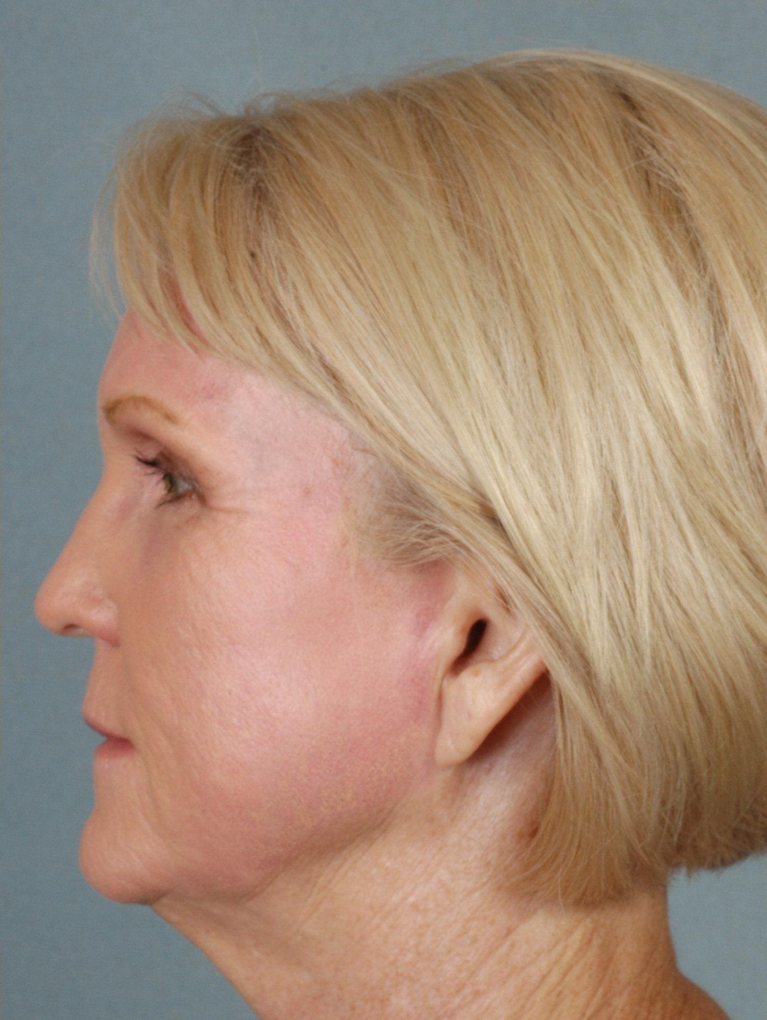 Laser Resurfacing Patient Photo - Case 15893 - after view-2