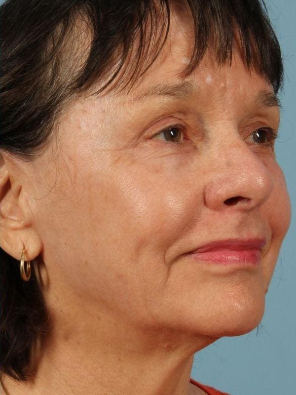 Laser Resurfacing Patient Photo - Case 15905 - after view-1