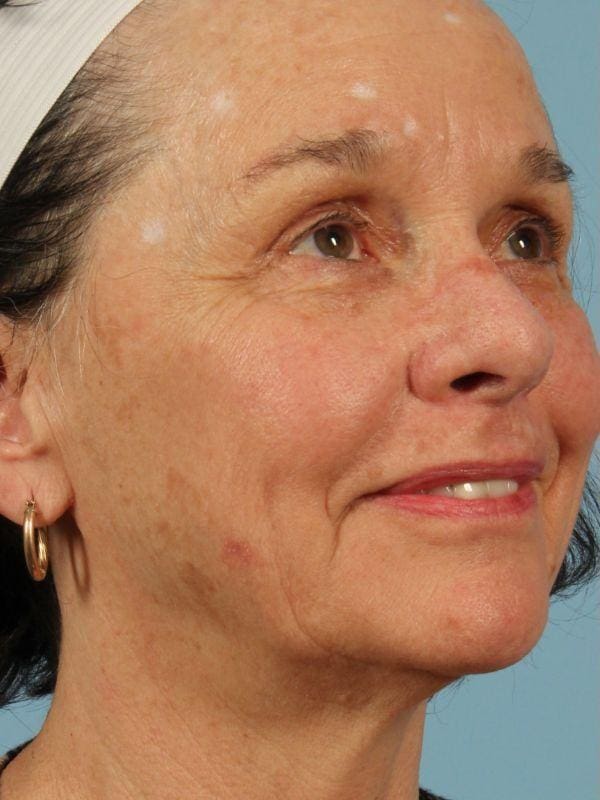 Laser Resurfacing Patient Photo - Case 15905 - before view-1