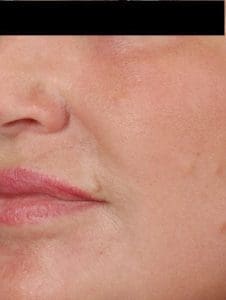 Laser Resurfacing - Case 15911 - After