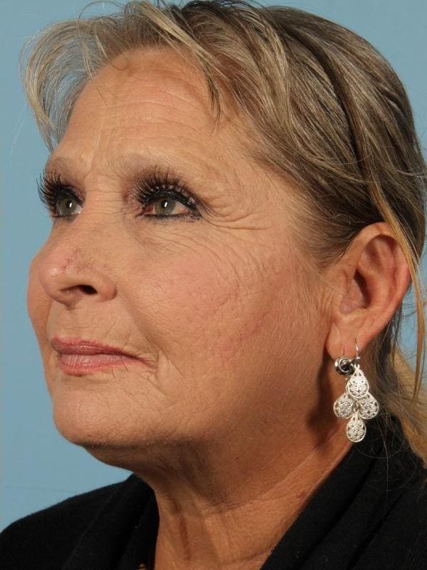 Laser Resurfacing Patient Photo - Case 15915 - after view-1