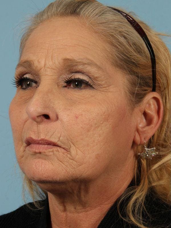 Laser Resurfacing Patient Photo - Case 15915 - before view-1