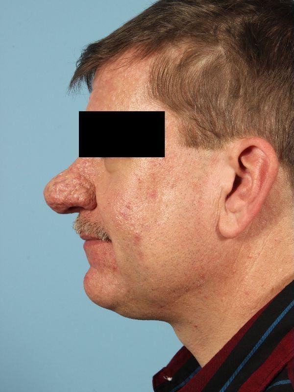 Laser Resurfacing Patient Photo - Case 15922 - before view-1