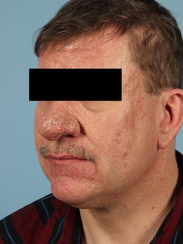Laser Resurfacing Patient Photo - Case 15922 - before view-2