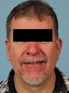 Laser Resurfacing - Case 15922 - After