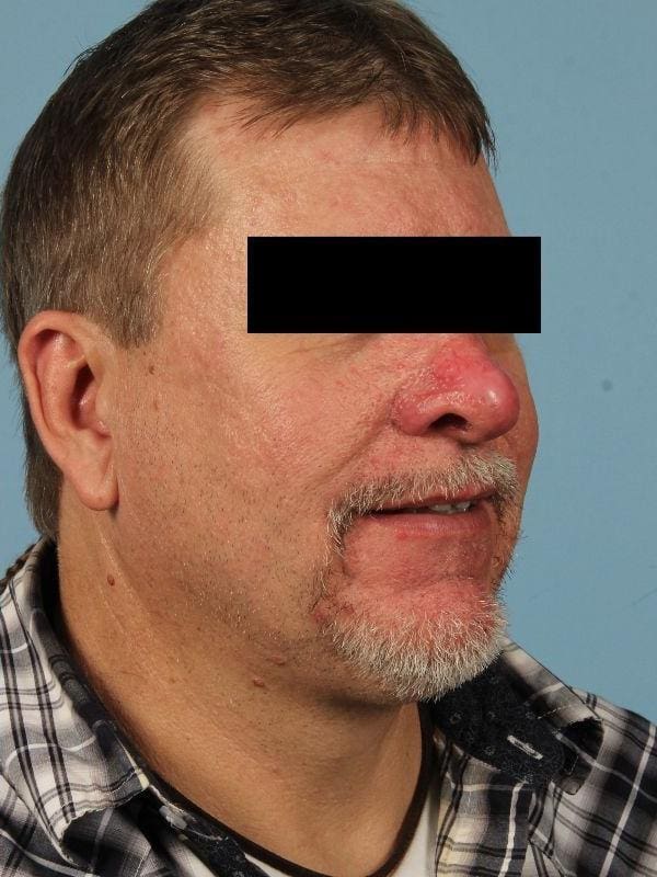 Laser Resurfacing Patient Photo - Case 15922 - after view-3