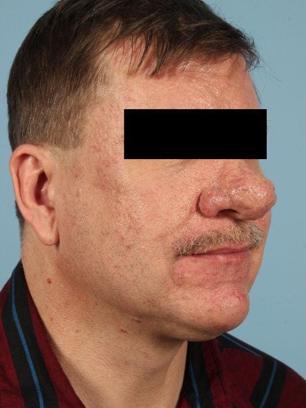 Laser Resurfacing Patient Photo - Case 15922 - before view-3
