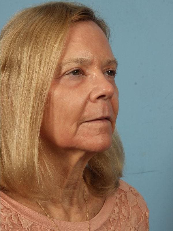 Laser Resurfacing Patient Photo - Case 15932 - after view-4