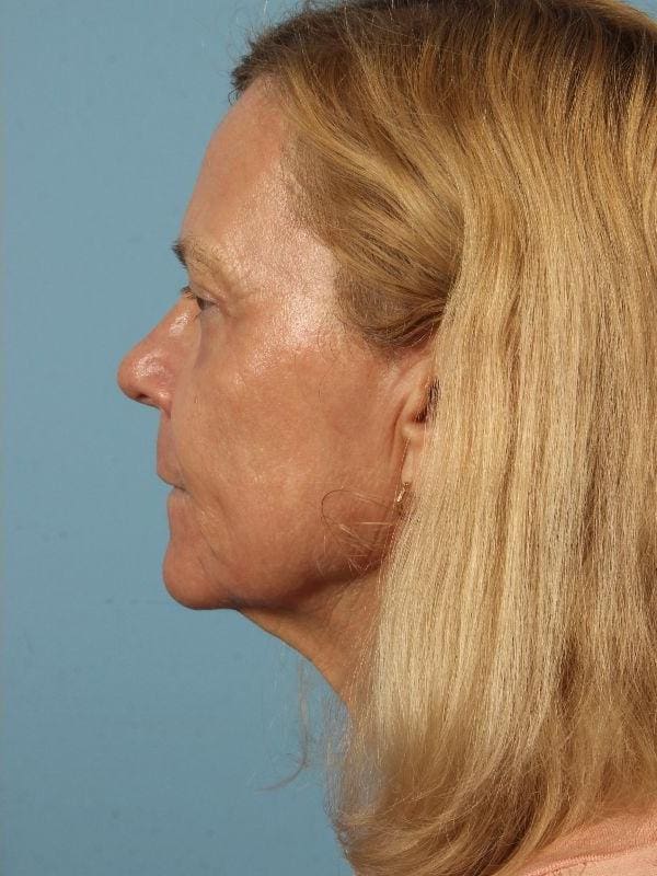 Laser Resurfacing Patient Photo - Case 15932 - after view-1