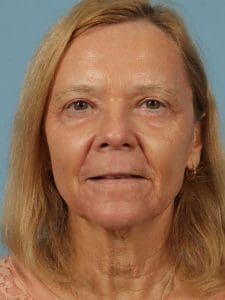 Laser Resurfacing - Case 15932 - After