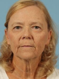 Laser Resurfacing - Case 15932 - Before