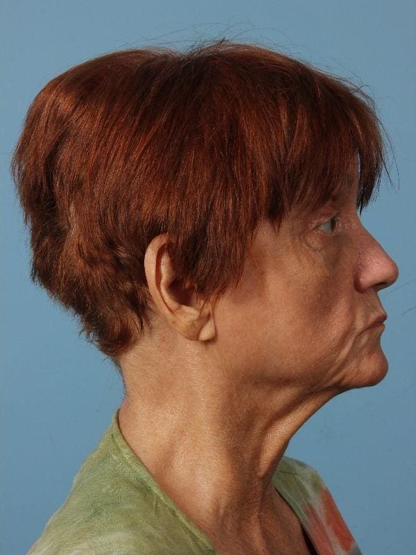 Laser Resurfacing Patient Photo - Case 15945 - after view-2
