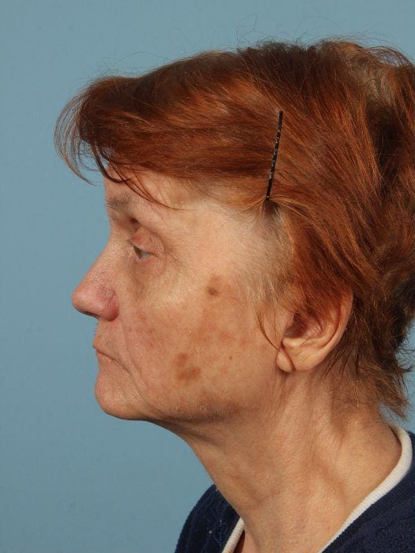 Laser Resurfacing Patient Photo - Case 15945 - before view-1