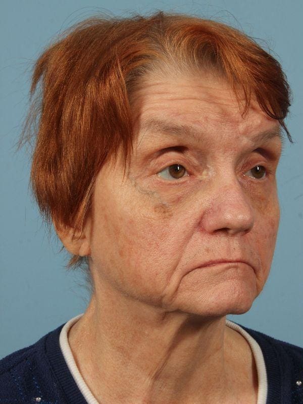 Laser Resurfacing Patient Photo - Case 15945 - before view-4