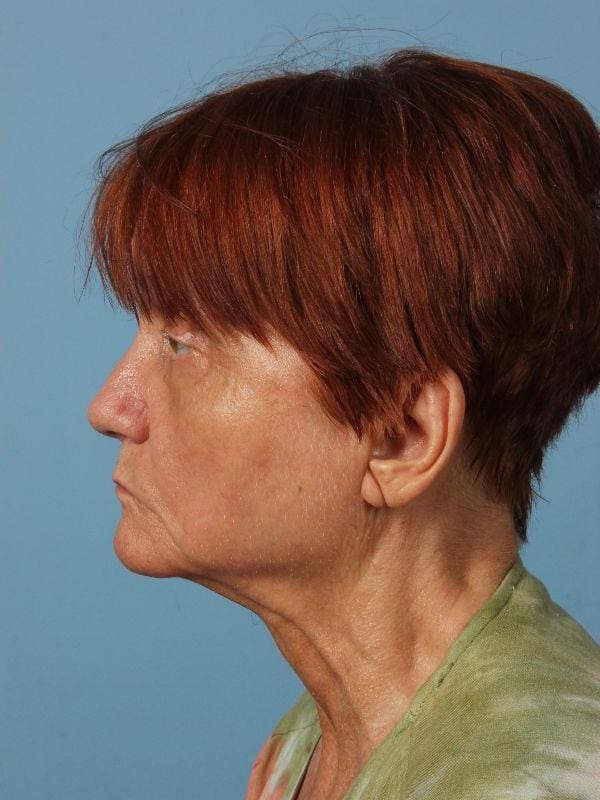 Laser Resurfacing Patient Photo - Case 15945 - after view-1