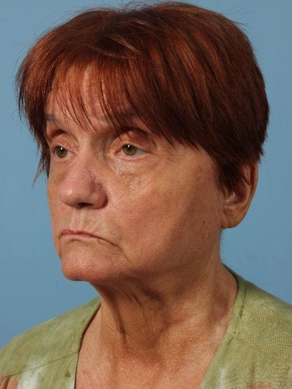 Laser Resurfacing Patient Photo - Case 15945 - after view-3