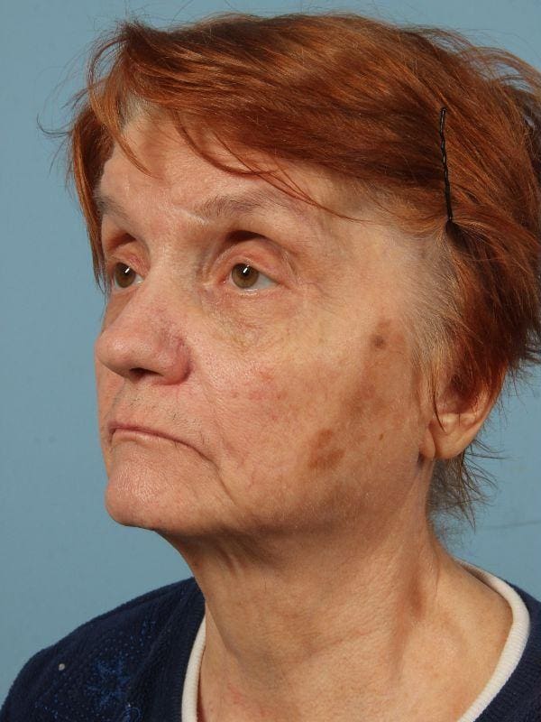 Laser Resurfacing Patient Photo - Case 15945 - before view-3