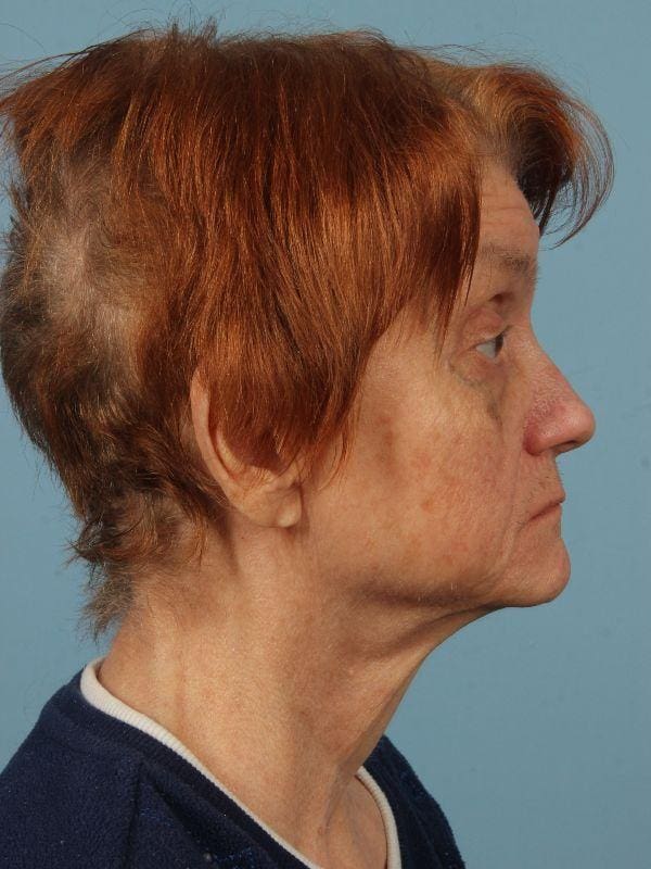 Laser Resurfacing Patient Photo - Case 15945 - before view-2
