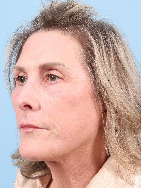 Laser Resurfacing Patient Photo - Case 15958 - after view-3