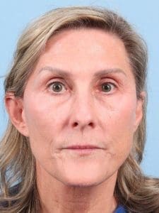 Laser Resurfacing - Case 15958 - Before