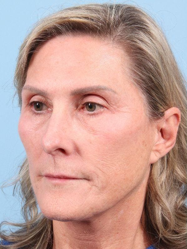 Laser Resurfacing Patient Photo - Case 15958 - before view-3