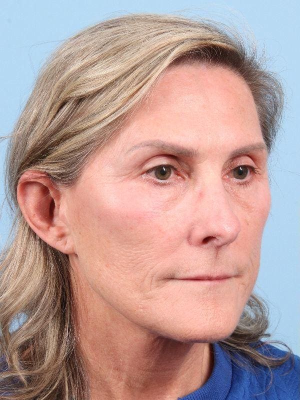 Laser Resurfacing Patient Photo - Case 15958 - before view-4