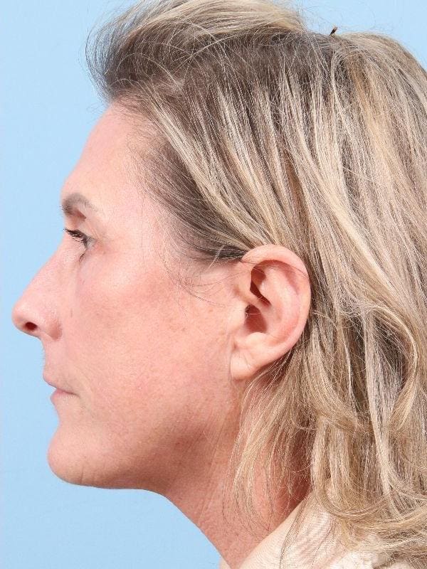 Laser Resurfacing Patient Photo - Case 15958 - after view-1