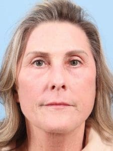 Laser Resurfacing - Case 15958 - After