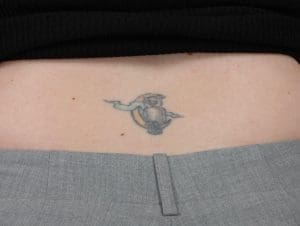 Laser Tattoo Removal - Case 15974 - Before