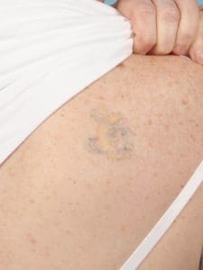 Laser Tattoo Removal - Case 15978 - After