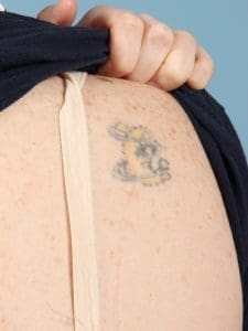 Laser Tattoo Removal - Case 15978 - Before