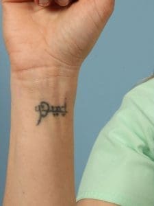 Laser Tattoo Removal - Case 15999 - Before