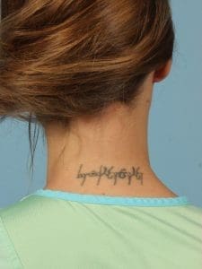 Laser Tattoo Removal - Case 16003 - Before