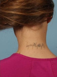 Laser Tattoo Removal - Case 16003 - After