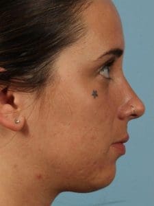 Laser Tattoo Removal - Case 16013 - Before