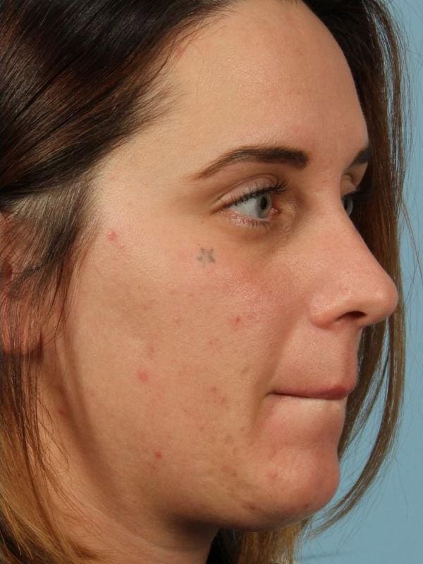 Laser Tattoo Removal Patient Photo - Case 16013 - after view-1