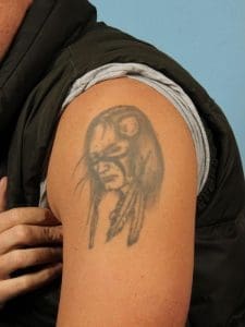 Laser Tattoo Removal - Case 16024 - Before