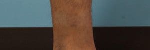 Laser Tattoo Removal - Case 16029 - After