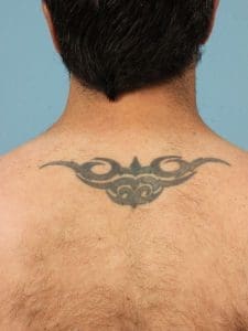 Laser Tattoo Removal - Case 16034 - Before
