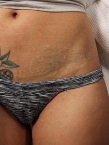 Laser Tattoo Removal - Case 16038 - After