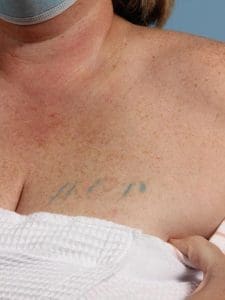 Laser Tattoo Removal - Case 16043 - After