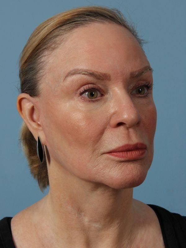 Laser Tattoo Removal Patient Photo - Case 16052 - before view-2