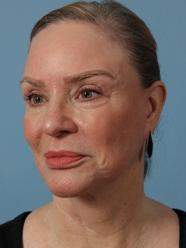 Laser Tattoo Removal Patient Photo - Case 16052 - before view-1