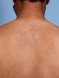 Laser Tattoo Removal - Case 16065 - After