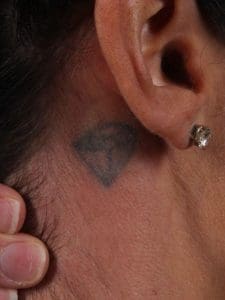 Laser Tattoo Removal - Case 16069 - Before