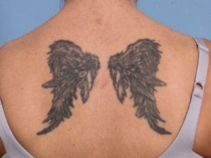 Laser Tattoo Removal - Case 16080 - Before