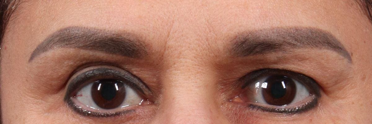 Laser Tattoo Removal Patient Photo - Case 16089 - before view-